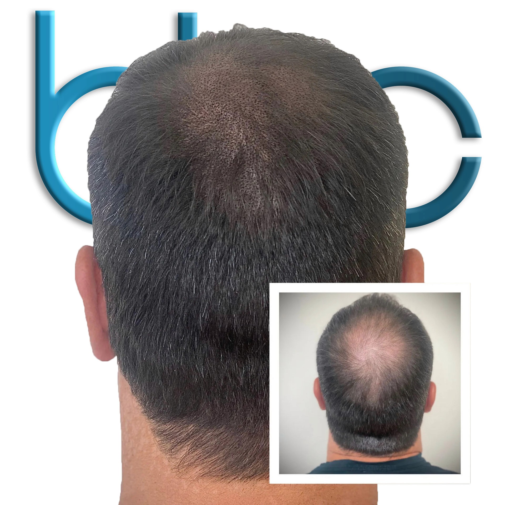 Back Coverage